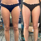 Zoovela™ - Anti-Cellulite Massager